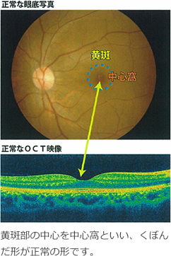 [正常な眼底]黄斑部の中心を中心窩といい、くぼんだ形が正常の形です。