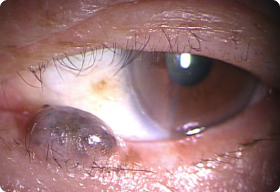 眼瞼腫瘍